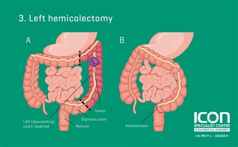 Colorectal Resection Colectomy — Icon Specialist Centre