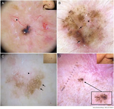 Dermoscopy In Basal Cell Carcinoma An Updated Review Actas Dermo