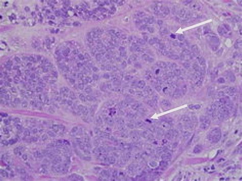 Invasive Ductal Carcinoma Histology