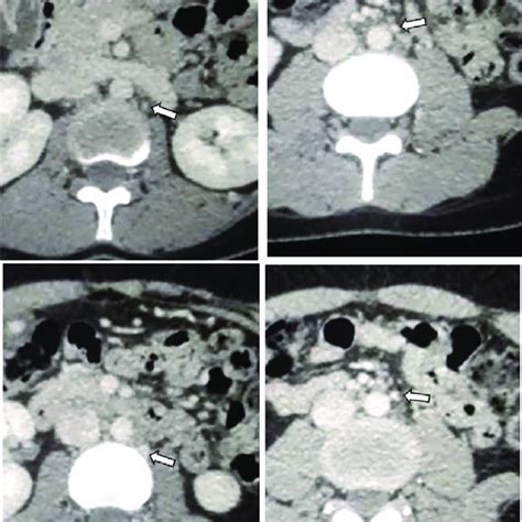 Ct Images Demonstrating Multiples Para Aortic Lymph Nodes The Largest