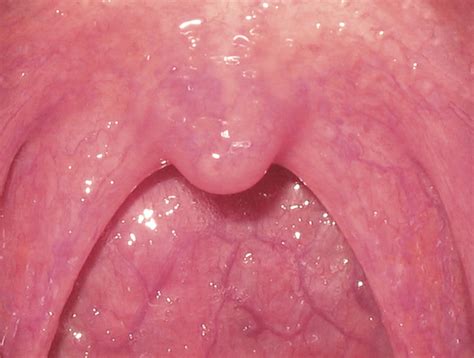 Pharyngitis Pictures Contagious Or Not Home Remedies Treatment