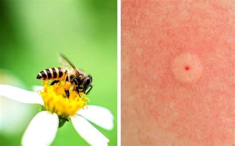 Identifying Bug Bites Heres What Bit You Readers Digest