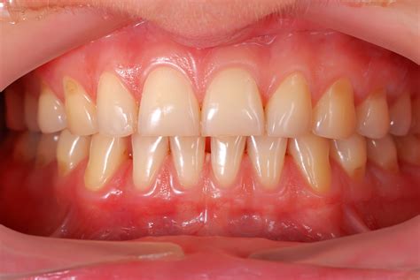 Gum Disease Glebe House Dental Care Dentist