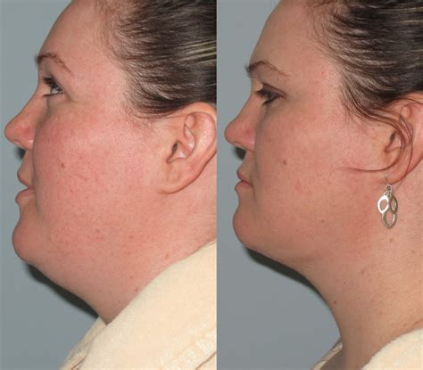 Female Chin Before After Laser Lipo