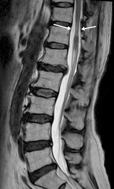 The Usefulness Of Lumbar Spine Mri For Cauda Equina Syndrome
