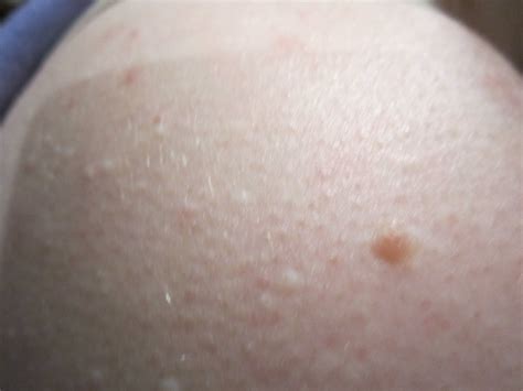 I Have White Spots On My Shoulders And Chest They Are Not