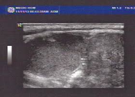 Vietnamese Medic Ultrasound Case Left Supraclavicular Mass Dr