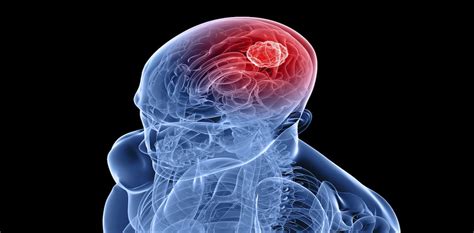 Glioblastoma Why These Brain Cancers Are So Difficult To Treat