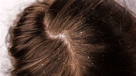Dandruff Vs Dry Scalp Differences And Best Treatments