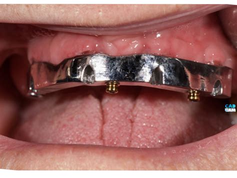 Overdenture su impianti con barra metallica – Alfa Dental Studio