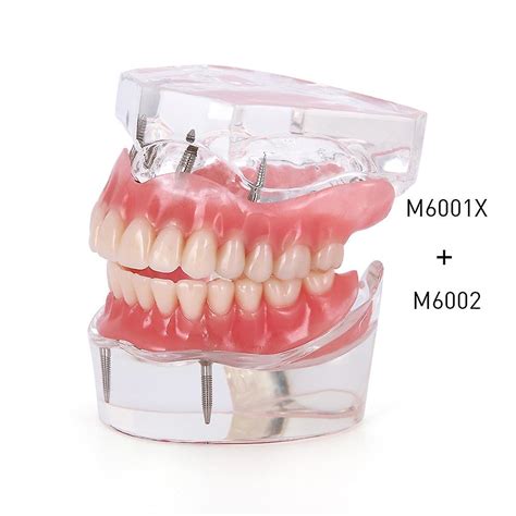 Tandimplantat Restaurering Tänder Modell Med Restaurering Bridge