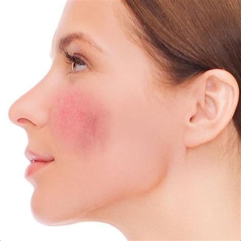 Facial Redness Laser Clinic Galway