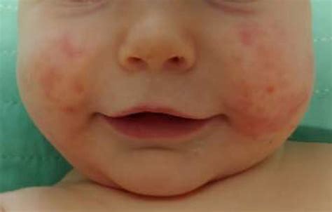 Infant With A Rapidly Progressing Rash Bmj Case Reports