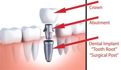 Dental Implants Frisco Tx Dr Mark Davis