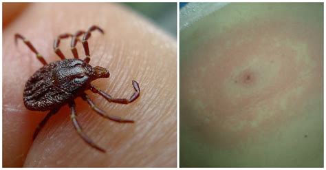 Tick Bites How To Avoid These Irksome And Dangerous Little Parasites