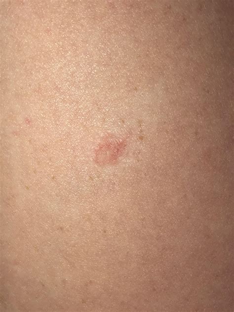 I Recently Noticed A Dry Red Patch On My Leg Can Anyone Tell Me What