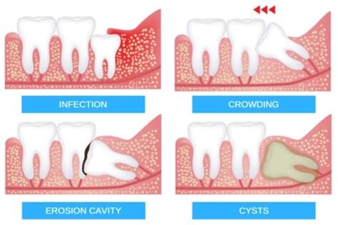 8 Things You Need To Know About Wisdom Teeth Tds Singapore