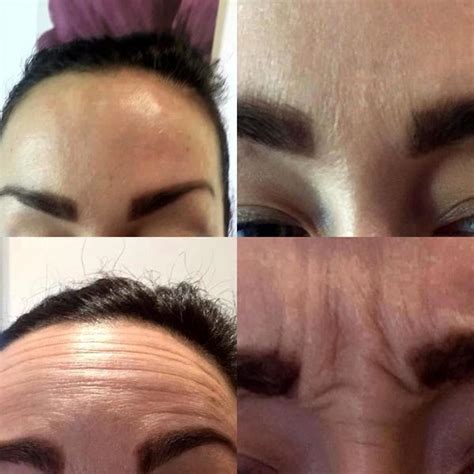 Botox For Nose And Forehead Wrinkles Before And After Facial
