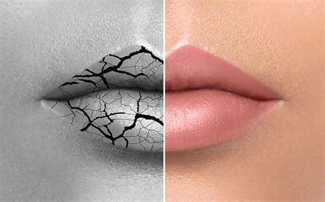 9 Effective Ways To Cure Chapped Lips Effectively Vedix