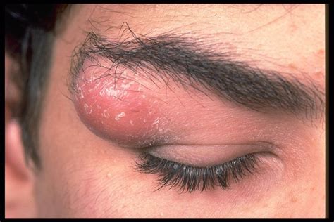 Dermoid Cysts Causes Symptoms Homeopathic Treatment