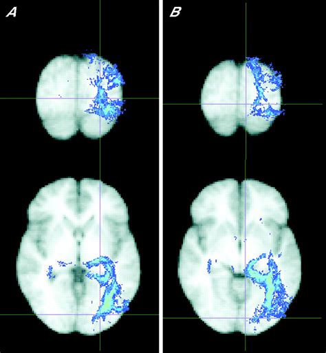 Visual Neglect After Right Posterior Cerebral Artery Infarction