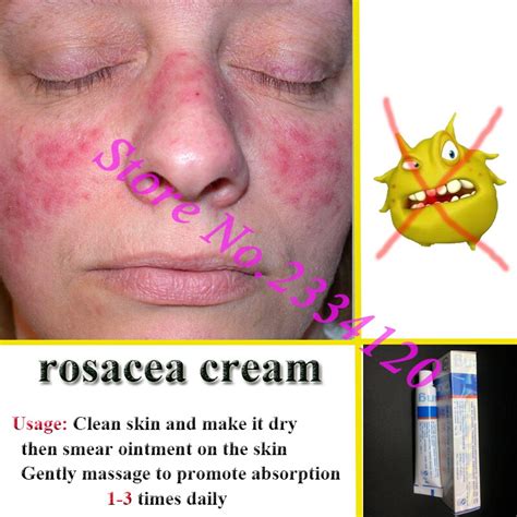 Read more about the kleresca® acne treatment here: Rosacea creme Rote nase salbe entfernen mitesser akne ...