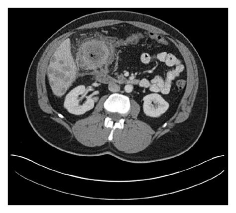 A Ct Scan Of The Abdomen Showing Innumerable Liver Metastases In A