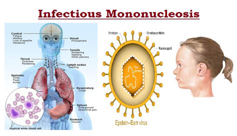 Mononucleosis Infekcijska Mononukleoza Wikipedija Prosta