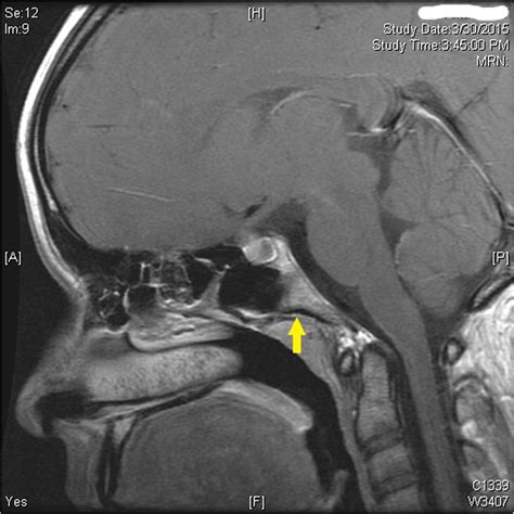 Sagittal T1 Mri Which Exemplifies The Consequence Of The Dorsal