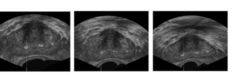 Deformation Of The Prostate Ultrasound Images Download Scientific Diagram