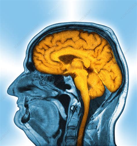 Normal Brain MRI Scan Stock Image P332 0497 Science Photo Library