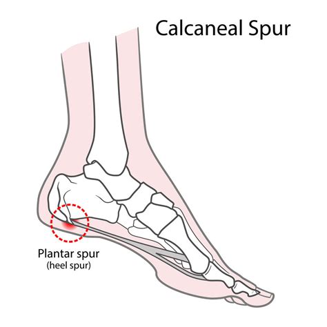 Calcaneal Spur Treatment Happywalk Orthopedic And Diabetic Footwear Store