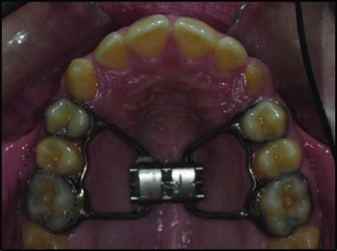 Tooth Borne Hyrax Expansion Appliance Anchored On Permanent Teeth Used