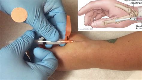 Corticosteroid Injection For Treatment Of De Quervains Tenosynovitis