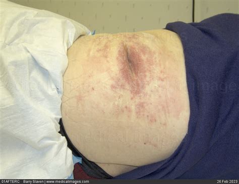 Stock Image Candida Rash Surrounding An Abdominal Incision This Kind