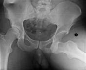 Congenital hip dislocation (chd) occurs when a child is born with an unstable hip. Anterior dislocation of the hip | Radiology Reference ...