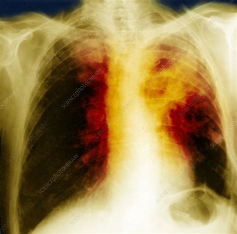 Asymmetry of lung density is represented as either abnormal whiteness (increased density), or abnormal blackness (decreased density). Lung Cancer, X-ray - Stock Image - C027/1366 - Science ...