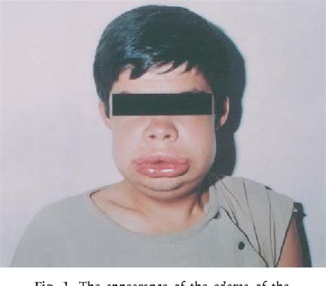 Figure 1 From A Case Of Hereditary Angioedema With Recurrent Arthritis