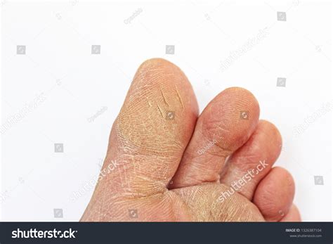 Cracked Skin Toe Isolated Stock Photo 1326387104 Shutterstock