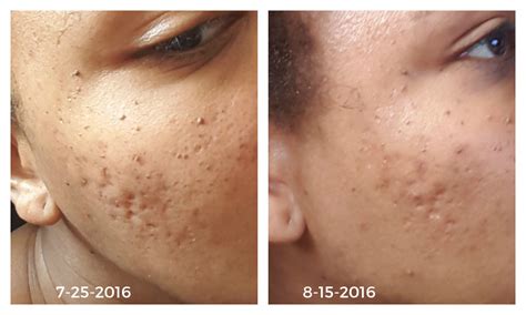 How I Got Rid Of Hyperpigmentation And Scars Naturally