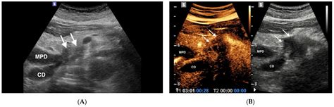 Chronic Pancreatitis Ultrasound
