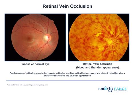 Retinal Vascular Occulsion Eent Content Blueprint Smarty Pance Panre
