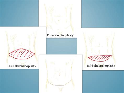 Difference Between Abdominoplasty And Mini Abdominoplasty