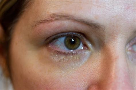 Harmless Small White Bumps Appearing Under The Eyes Or On The Eyelids