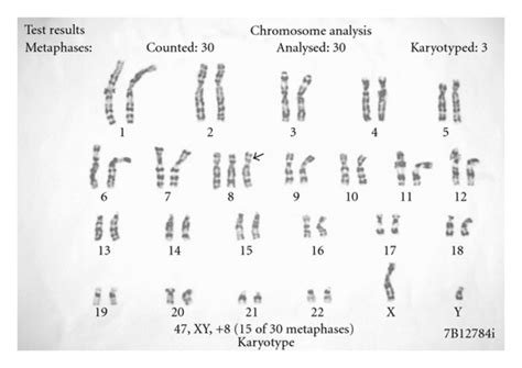 Karyotyping Showing Trisomy 8 Download Scientific Diagram