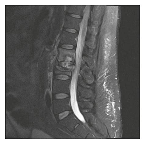Mri Lumbar Spine With And Without Contrast Revealing The Compression