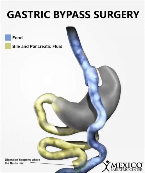 weight gain after rny gastric bypass surgery how to fix it