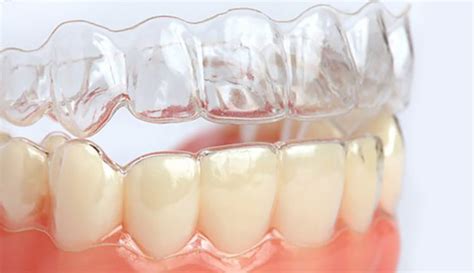 Advantages Of Invisible Orthodontics Dr Jamilian