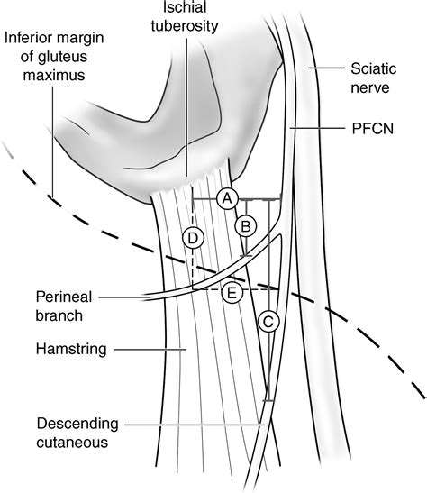 The Posterior Femoral Cutaneous Nerve And Branches Are In Proximity To