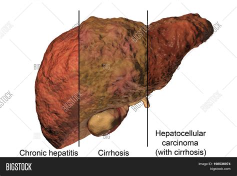 Liver Disease Image And Photo Free Trial Bigstock